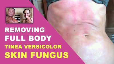 Removing Full Body Tinea Versicolor Skin Fungus