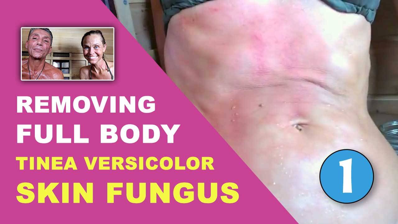 Removing Full Body Tinea Versicolor Skin Fungus Part 1