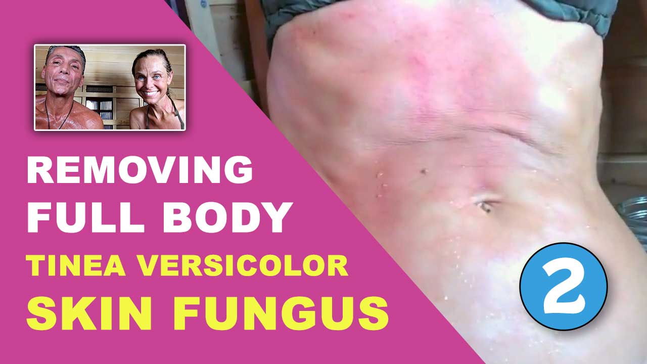 Removing Full Body Tinea Versicolor Skin Fungus Part 2