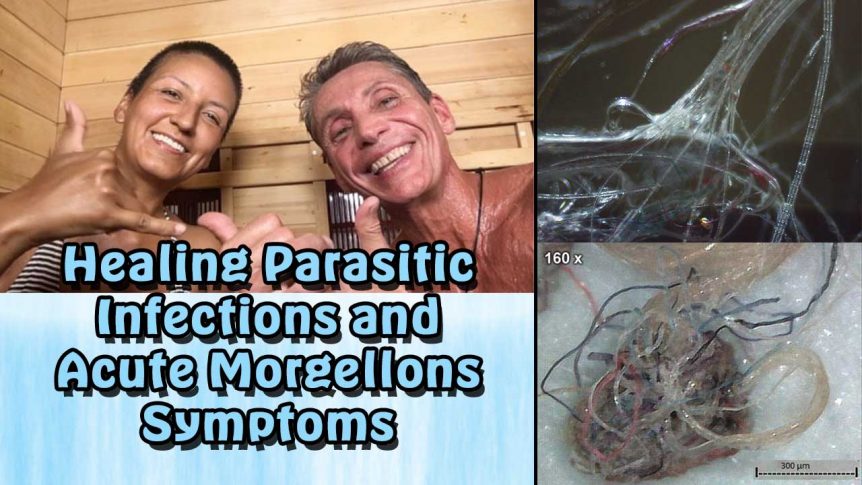Healing Parasitic Infections and Acute Morgellons Symptoms