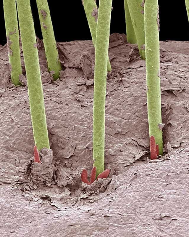 Hair Mites and Parasites in Scalp