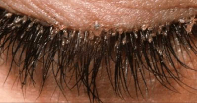 Hair Mites in Eye Lids