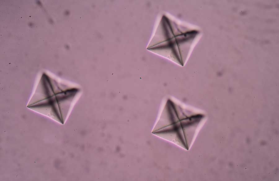 Calcium Oxalate Crystal In Urine Analysis