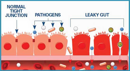 Graphic of Leaky Gut Info